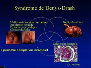 Syndrome de Denys Drash