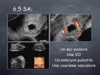 Grossesse sur cicatrice de césarienne