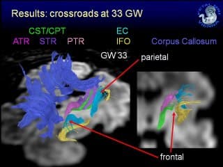 tractographie des voies periventriculaires ( en ANGLAIS )