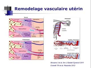 Le 1er trimestre Le Doppler des artères utérines au 1er trimestre : où en sommes-nous ?