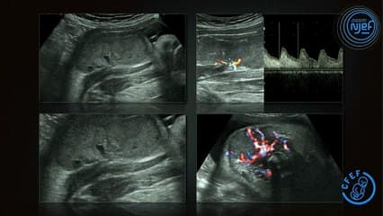 Hemangiomes congenitaux