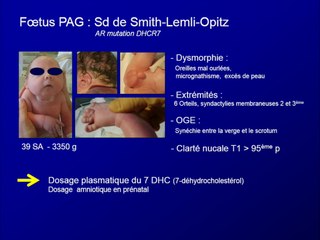 10 syndromes avec anomalies de la croissance