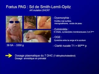 10 syndromes avec anomalies de la croissance