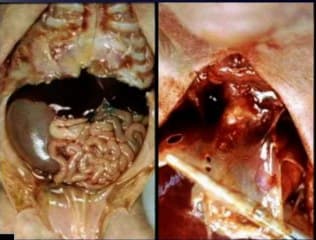 Syndrome PMD (agénésie pulmonaire-microphtalmie-eventration diaphragmatique)