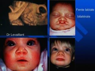 Dépistage des malformations de la face. La performance prénatale est-elle synonyme de bénéfice post-natal ?