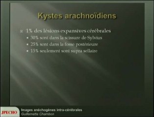 Images anéchogènes intra-cérébrales
