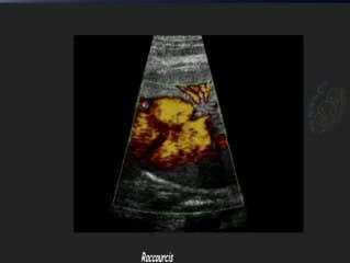 Retour veineux azygos