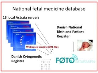Etat des lieux du Diagnostic Prénatal Méthodes et résultats l'exemple du Danemark
