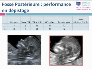 Le point sur le spina bifida : Pertinence de la clarté intracérébrale pour le dépistage des myélomeningocèles en population
