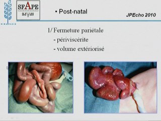 laparoschisis