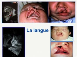 Fente labio-palatine isolée : Prise en charge chirurgicale