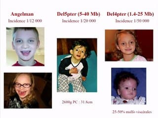 DPNI et syndromes microdéltionnels