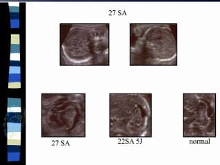 Rhombencéphalosnapsis