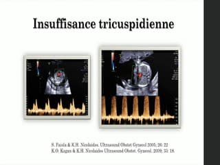 Second stage screening.