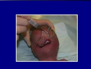 Dysplasie frontonasale