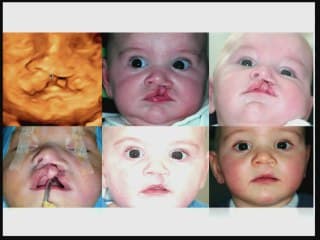 pronostic esthetique des fentes labiales en échographie 3D