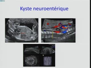 Pathologie anténatale du rachis foetal