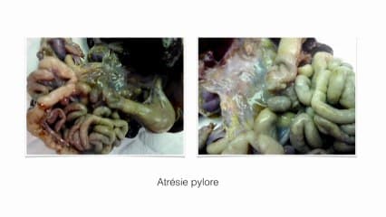 Syndrome de cimeterre