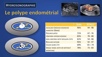 Analyse de l’endomètre et terminologie proposée par l’International Endometrial Tumor Analysis (IETA) : premiers résultats