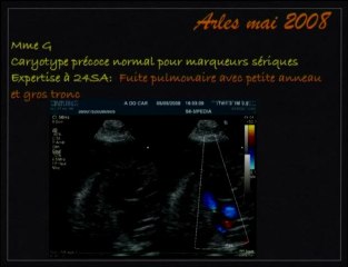 Tétralogie de Fallot pronostic