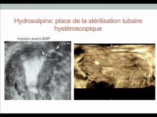 Dispositif Essure et hydrosalpinx : étonnante association.