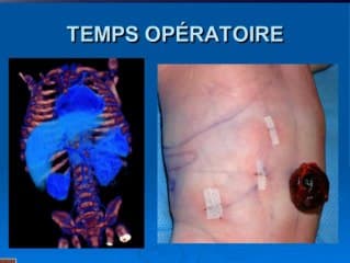 Neuroblastome surrénalien