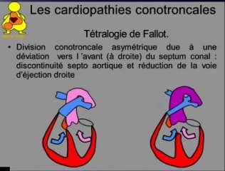 Les anomalies cono troncales rappel embryologique