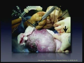 échographie du cou foetal