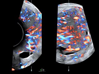 Pathologies néoplasiques du col