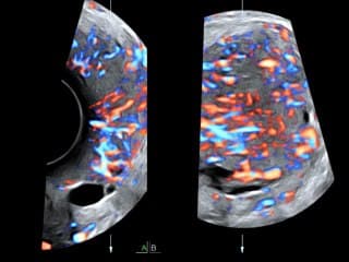 Pathologies néoplasiques du col