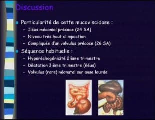 Ileus méconial compliqué