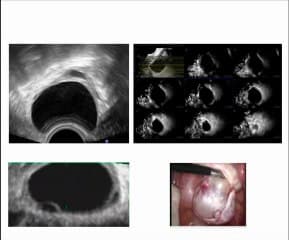 Classification échographique des tumeurs de l’ovaire
