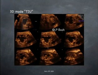 Dilatation des cavités rénales