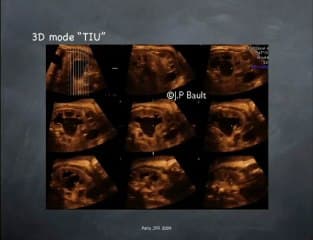 Dilatation des cavités rénales