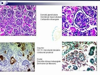 Syndrome néphrotique finlandais