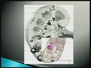 Les ciliopathies rénales - de l'échographie au phénotype.