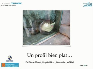 arhinie congénitale totale