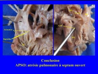 Atrésie pulmonaire à septum ouvert