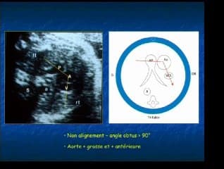 Pertinence de la coupe de la bifurcation de l'artère Pertinence de la coupe de la bifurcation de l'artère