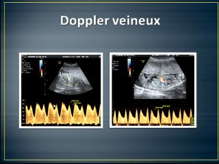 Quelle évaluation échographique pronostique du RCIU ? (échographie « focalisée »)