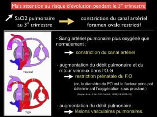 Pronostic des malformations cardiaques découvertes in utero : l’avis du cardiopédiatre