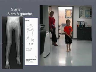 Pronostic d’une hypoplasie d’un membre inférieur.