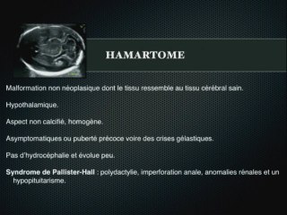 tumeurs cérébrales foetales