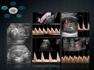 Découverte d'un fémur court