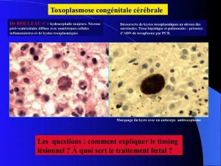 toxoplasmose congenitale