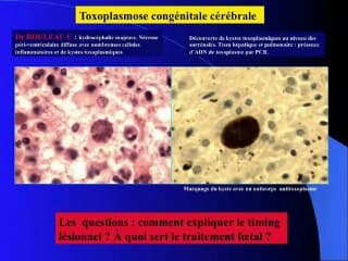 toxoplasmose congenitale