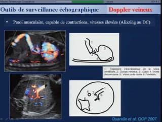 Conduite à tenir devant un retard de croissance intra-utérin (RCIU)