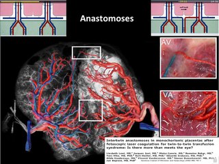 Complications des grossesses gémellaires