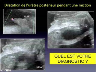 une uropathie obstructive cas cliniques