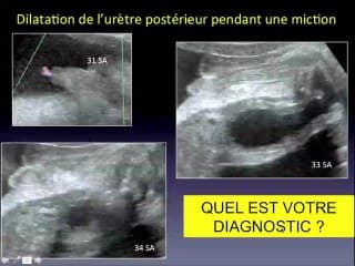 une uropathie obstructive cas cliniques